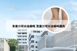 生姜汁可以治癣吗 生姜汁可以治癣吗图片