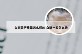 白斑最严重是怎么样的 白斑一般怎么治