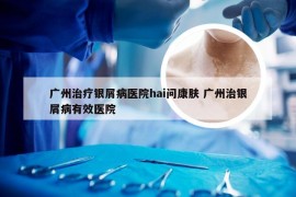 广州治疗银屑病医院hai问康肤 广州治银屑病有效医院