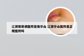 辽源银屑病医院皆推华山 辽源华山医院是正规医院吗