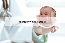 牛皮癣好了为什么又发红