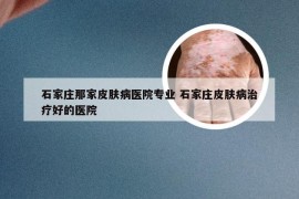 石家庄那家皮肤病医院专业 石家庄皮肤病治疗好的医院