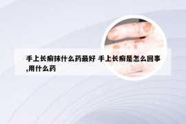 手上长癣抹什么药最好 手上长癣是怎么回事,用什么药