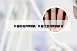 长春哪看白斑病好 长春检查白斑病价格