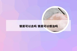 银屑可以去吗 银屑可以根治吗