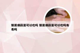 银屑病蒜苗可以吃吗 银屑病蒜苗可以吃吗有毒吗