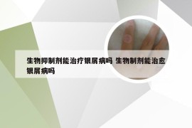 生物抑制剂能治疗银屑病吗 生物制剂能治愈银屑病吗