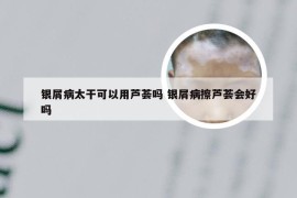 银屑病太干可以用芦荟吗 银屑病擦芦荟会好吗