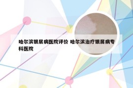 哈尔滨银屑病医院评价 哈尔滨治疗银屑病专科医院