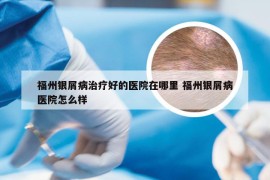 福州银屑病治疗好的医院在哪里 福州银屑病医院怎么样