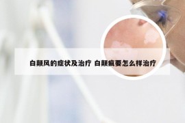 白颠风的症状及治疗 白颠疯要怎么样治疗