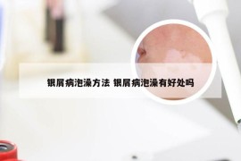 银屑病泡澡方法 银屑病泡澡有好处吗