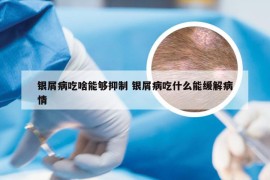 银屑病吃啥能够抑制 银屑病吃什么能缓解病情