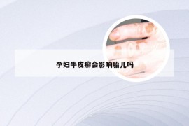 孕妇牛皮癣会影响胎儿吗