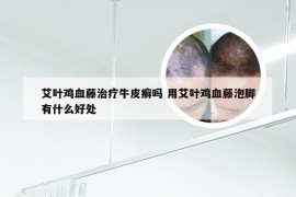 艾叶鸡血藤治疗牛皮癣吗 用艾叶鸡血藤泡脚有什么好处