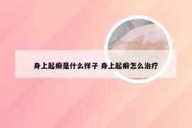 身上起癣是什么样子 身上起癣怎么治疗