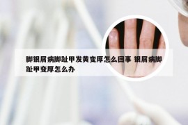 脚银屑病脚趾甲发黄变厚怎么回事 银屑病脚趾甲变厚怎么办