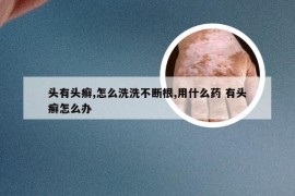 头有头癣,怎么洗洗不断根,用什么药 有头癣怎么办