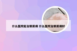 什么医院能治银屑病 什么医院治银屑病好