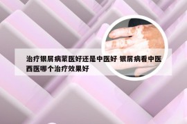 治疗银屑病蒙医好还是中医好 银屑病看中医西医哪个治疗效果好