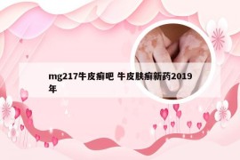 mg217牛皮癣吧 牛皮肤癣新药2019年