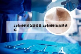 21金维他对白斑效果 21金维他治皮肤病吗