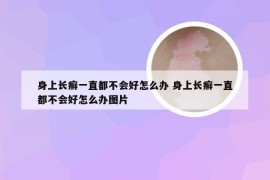 身上长癣一直都不会好怎么办 身上长癣一直都不会好怎么办图片