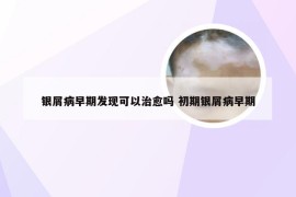 银屑病早期发现可以治愈吗 初期银屑病早期