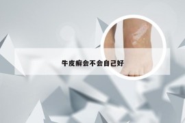 牛皮癣会不会自己好