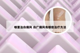 哪里治白癜风 白广癜风有哪些治疗方法