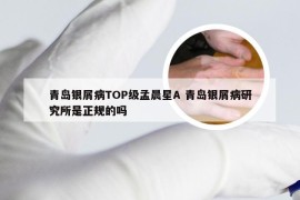 青岛银屑病TOP级孟晨星A 青岛银屑病研究所是正规的吗