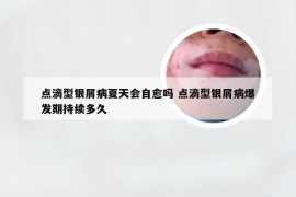 点滴型银屑病夏天会自愈吗 点滴型银屑病爆发期持续多久