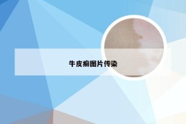 牛皮癣图片传染