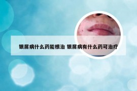 银屑病什么药能根治 银屑病有什么药可治疗