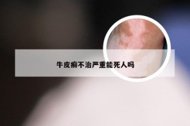 牛皮癣不治严重能死人吗