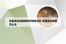 真菌感染的脚癣如何彻底治好 真菌感染脚癣怎么治