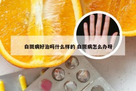 白斑病好治吗什么样的 白斑病怎么办呀