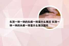 头顶一块一块的头癣一样是什么情况 头顶一块一块的头癣一样是什么情况图片