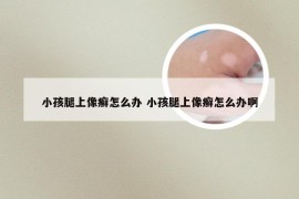 小孩腿上像癣怎么办 小孩腿上像癣怎么办啊