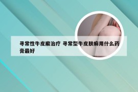 寻常性牛皮廨治疗 寻常型牛皮肤癣用什么药膏最好