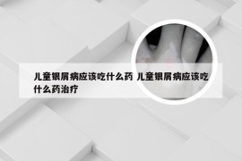 儿童银屑病应该吃什么药 儿童银屑病应该吃什么药治疗