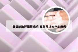 臭氧能治好银屑病吗 臭氧可以治疗皮癣吗