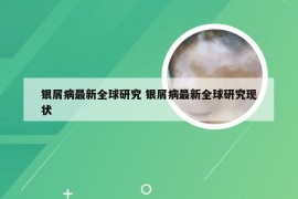 银屑病最新全球研究 银屑病最新全球研究现状