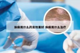 体癣用什么药膏效果好 体癣用什么治疗