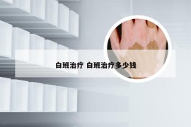 白班治疗 白班治疗多少钱