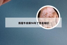 我是牛皮癣56年了想去咱们