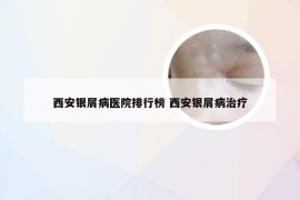 西安银屑病医院排行榜 西安银屑病治疗