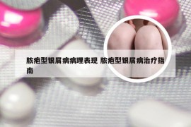 脓疱型银屑病病理表现 脓疱型银屑病治疗指南