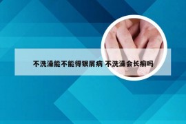 不洗澡能不能得银屑病 不洗澡会长癣吗