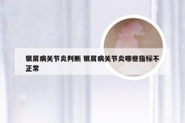 银屑病关节炎判断 银屑病关节炎哪些指标不正常